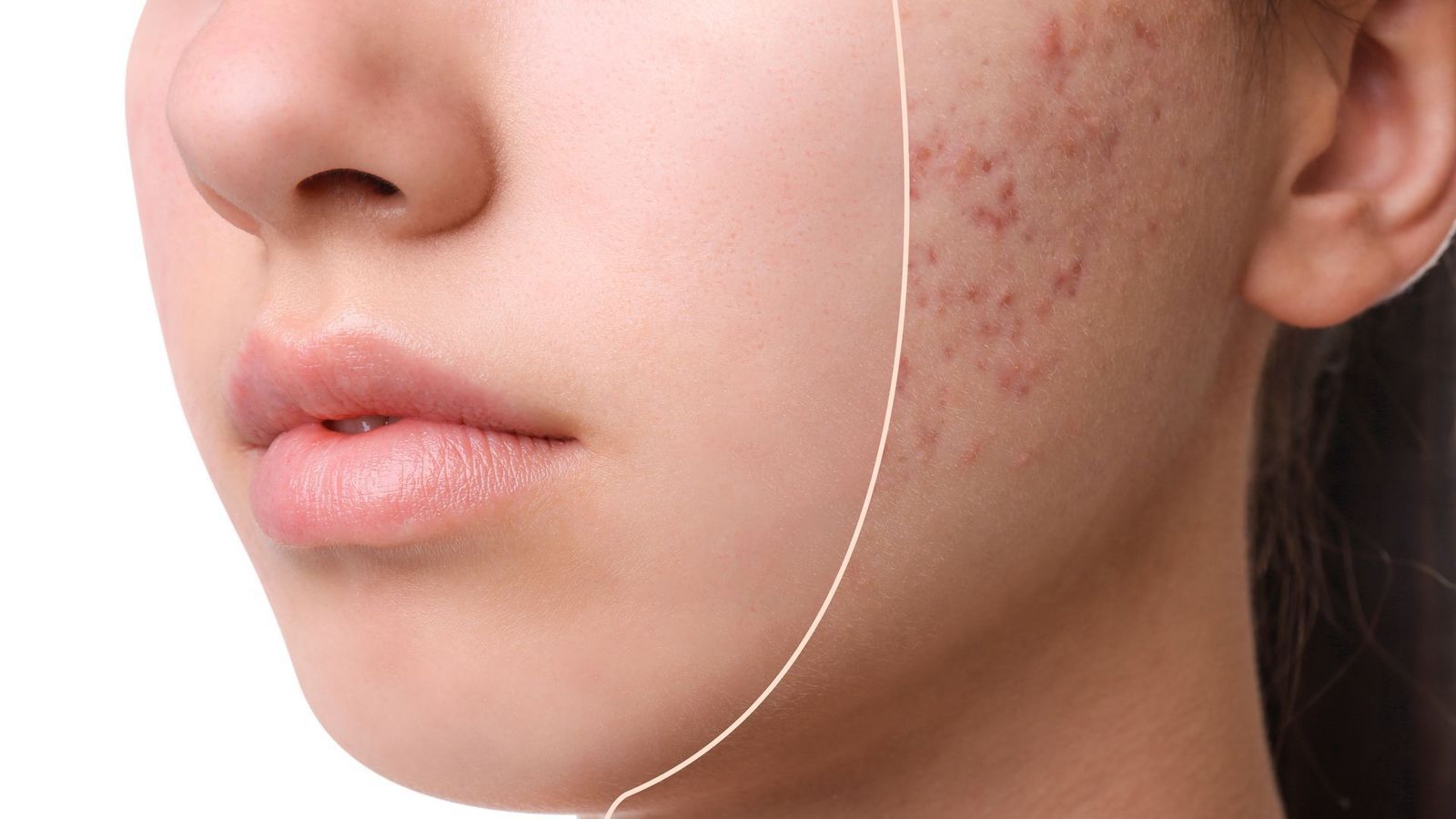 Close-up of a young woman's cheek with acne marks and uneven skin texture
