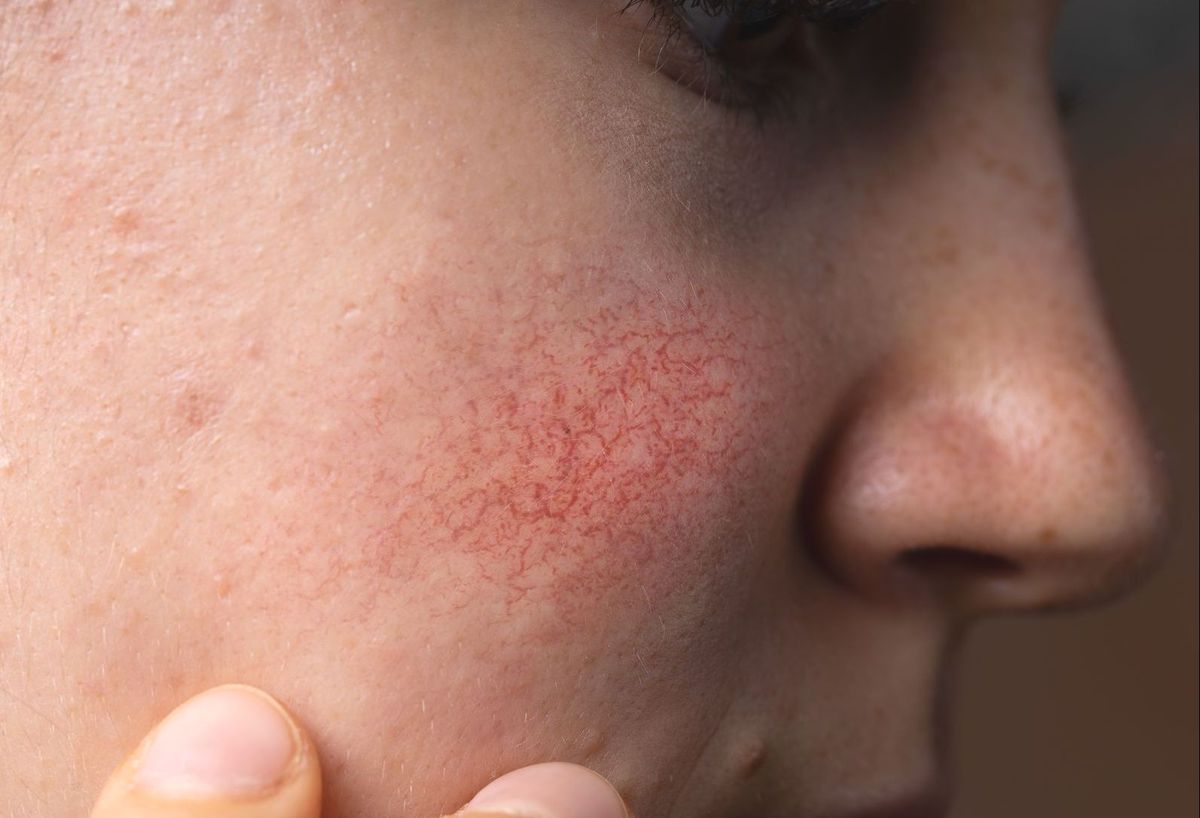 Close-up of cheek skin with redness and uneven texture, the kind of concern microneedling can improve