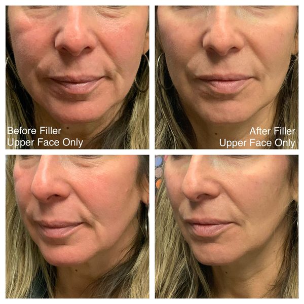 Before and after photo 9 of 14: lift, sculpt, define and contour