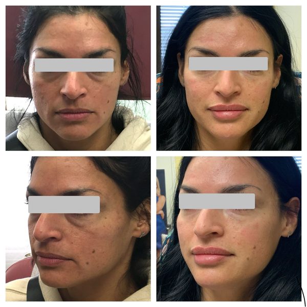 Before and after photo 11 of 14: lift, sculpt, define and contour