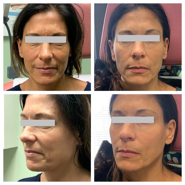 Before and after photo 7 of 14: lift, sculpt, define and contour