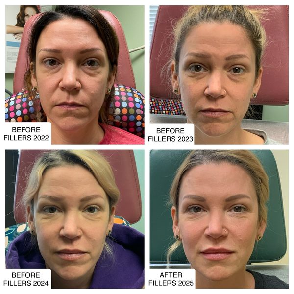 Before and after photo 1 of 14: lift, sculpt, define and contour
