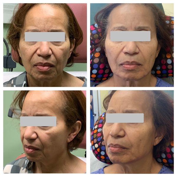 Before and after photo 6 of 14: lift, sculpt, define and contour