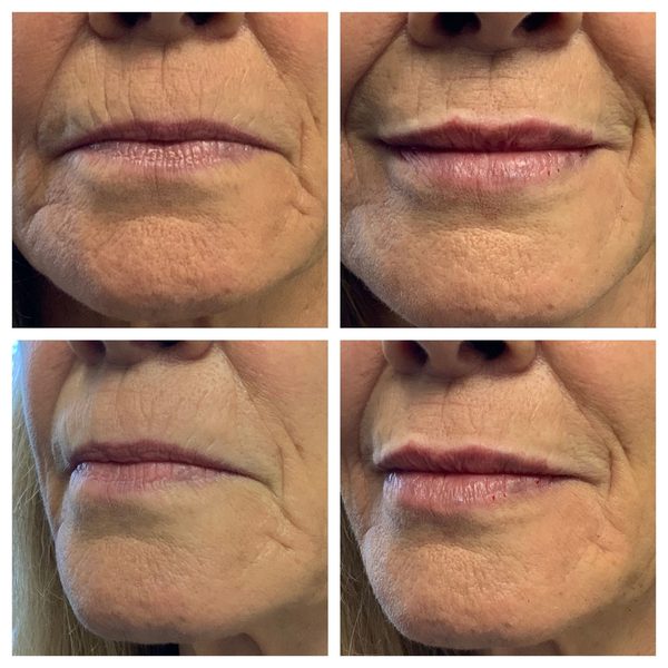 Before and after photo 4 of 16: aging lips and vertical lip lines
