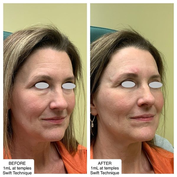 Before and after photo 5 of 14: lift, sculpt, define and contour