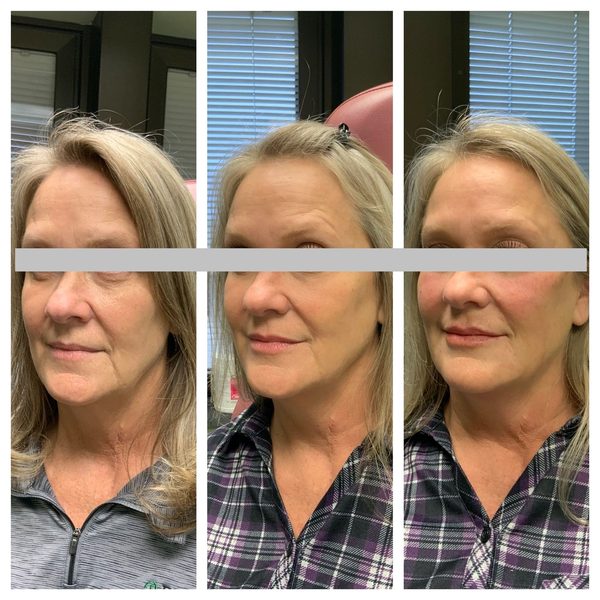 Before and after photo 4 of 14: lift, sculpt, define and contour