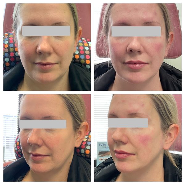 Before and after photo 8 of 14: lift, sculpt, define and contour