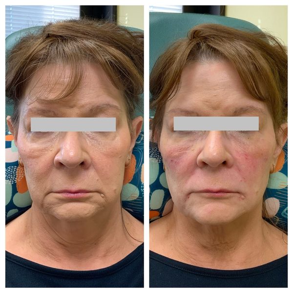 Before and after photo 13 of 14: lift, sculpt, define and contour