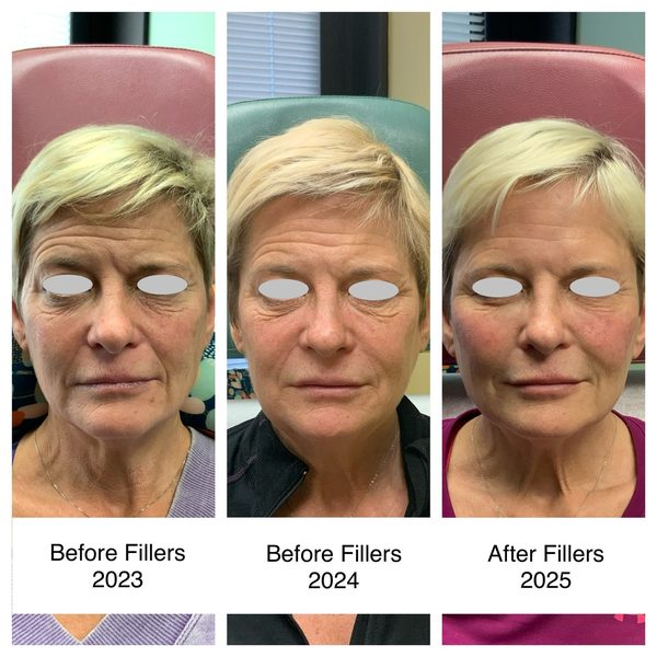 Before and after photo 2 of 14: lift, sculpt, define and contour