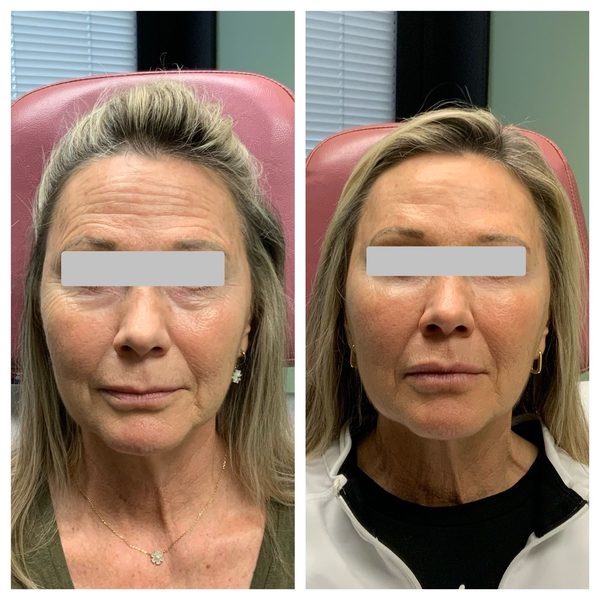 Before and after photo 10 of 14: lift, sculpt, define and contour