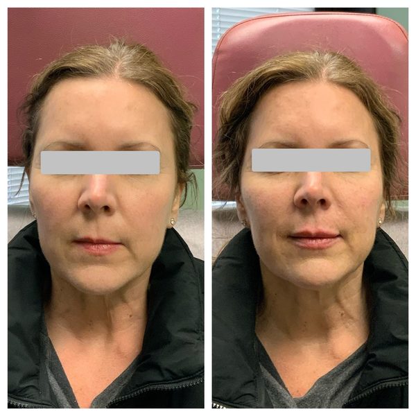 Before and after photo 14 of 14: lift, sculpt, define and contour