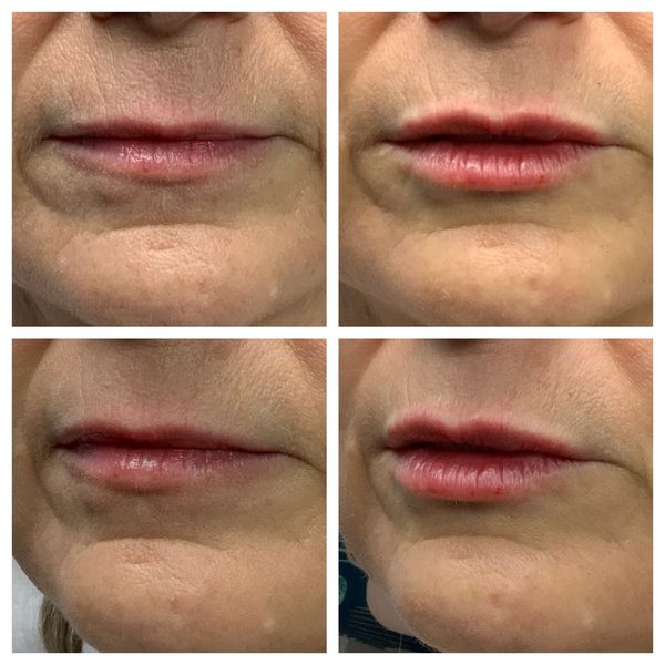Before and after photo 9 of 16: aging lips and vertical lip lines