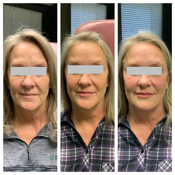 Before and after photo 3 of 14: lift, sculpt, define and contour