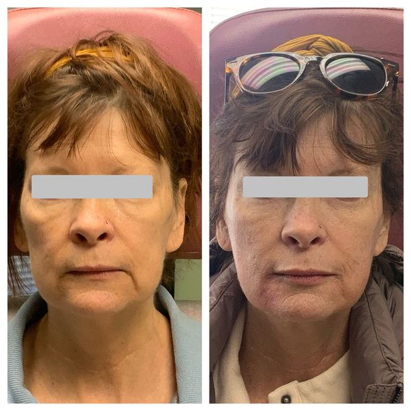 Before and after photo 12 of 14: lift, sculpt, define and contour