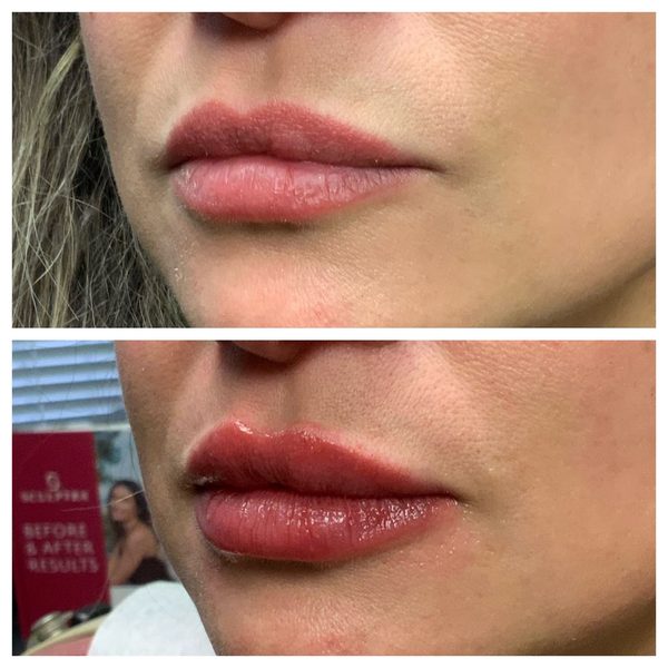 Before and after photo 4 of 12: lip volume and enhancement