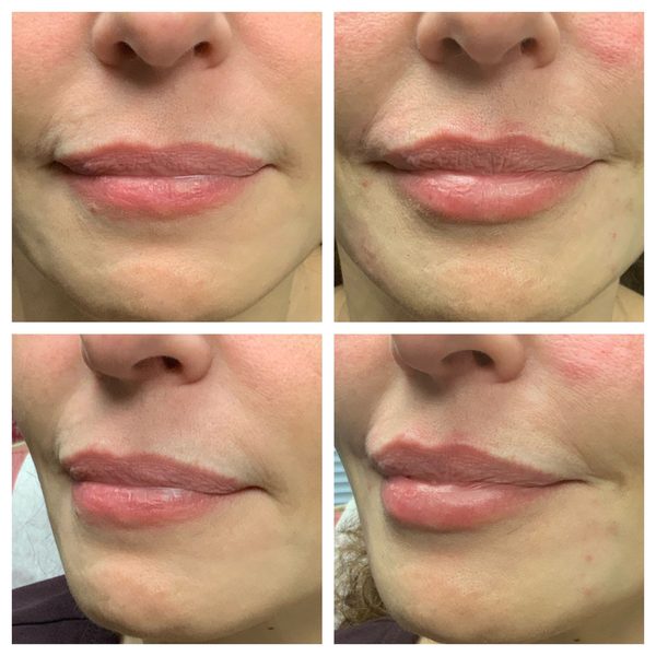 Before and after photo 3 of 12: lip volume and enhancement