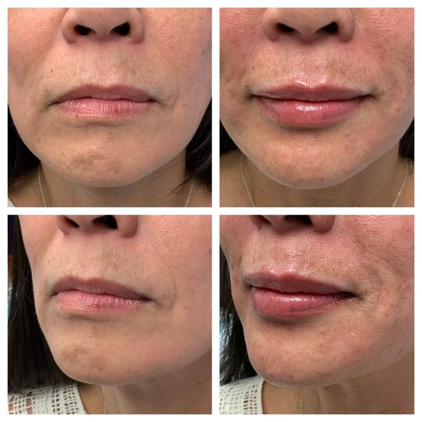 Before and after photo 12 of 16: aging lips and vertical lip lines