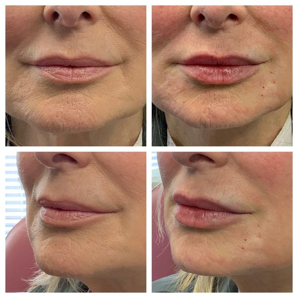 Before and after photo 1 of 16: aging lips and vertical lip lines