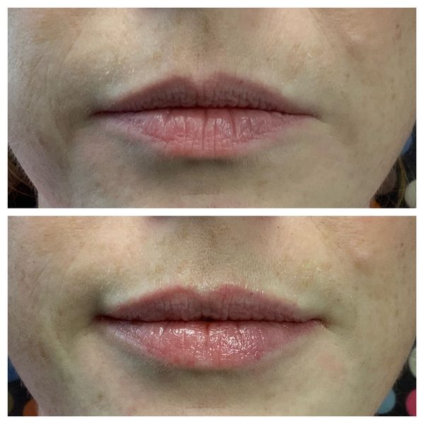 Before and after photo 6 of 12: lip volume and enhancement