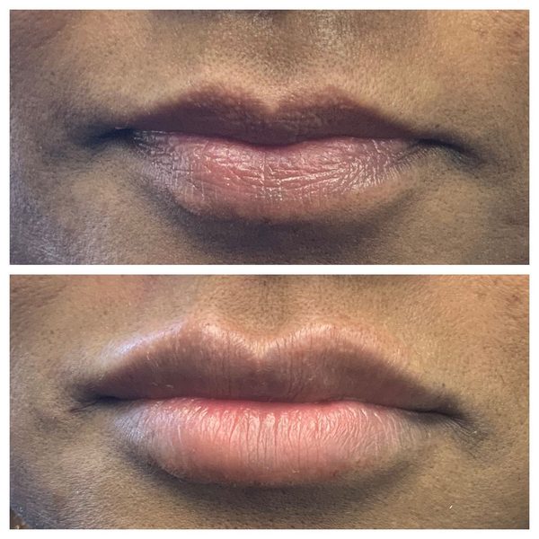 Before and after photo 10 of 12: lip volume and enhancement