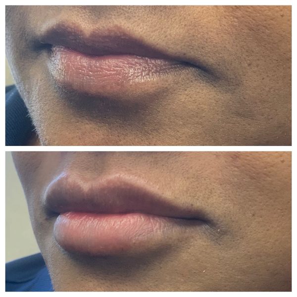 Before and after photo 9 of 12: lip volume and enhancement