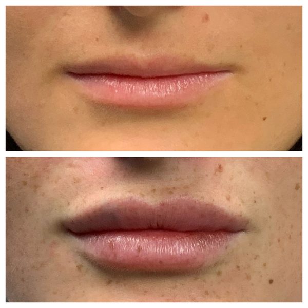 Before and after photo 12 of 12: lip volume and enhancement