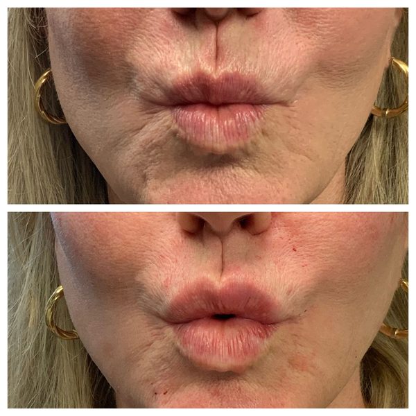 Before and after photo 13 of 16: aging lips and vertical lip lines
