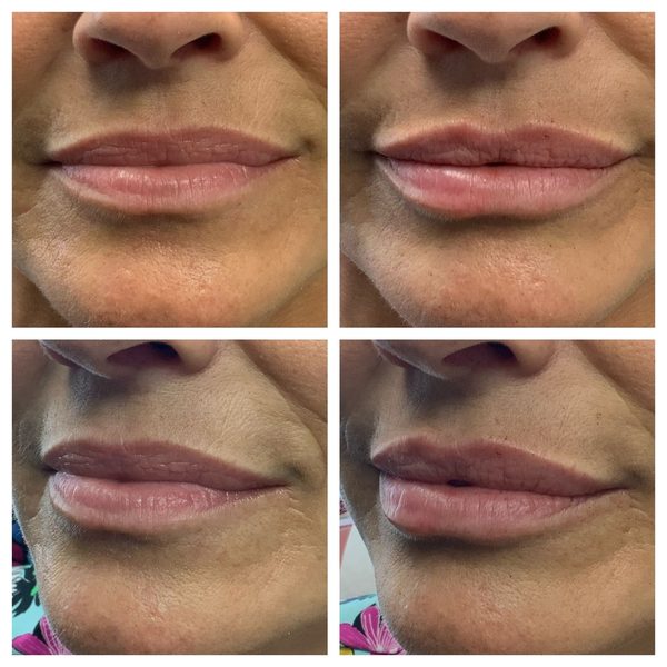 Before and after photo 11 of 16: aging lips and vertical lip lines