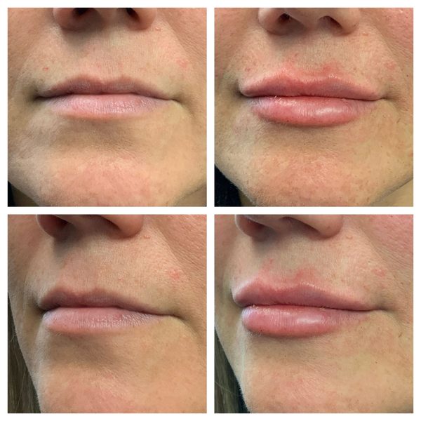 Before and after photo 8 of 12: lip volume and enhancement