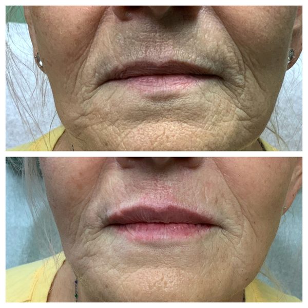 Before and after photo 15 of 16: aging lips and vertical lip lines