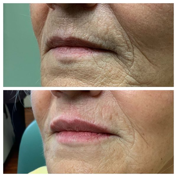 Before and after photo 14 of 16: aging lips and vertical lip lines