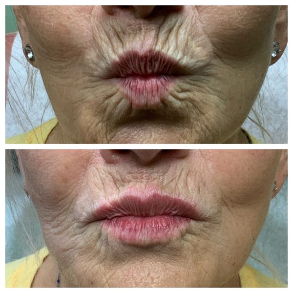 Before and after photo 16 of 16: aging lips and vertical lip lines