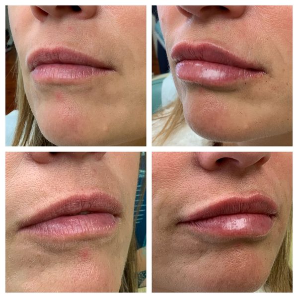 Before and after photo 5 of 12: lip volume and enhancement