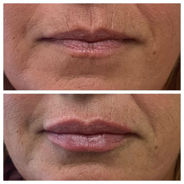 Before and after photo 2 of 16: aging lips and vertical lip lines