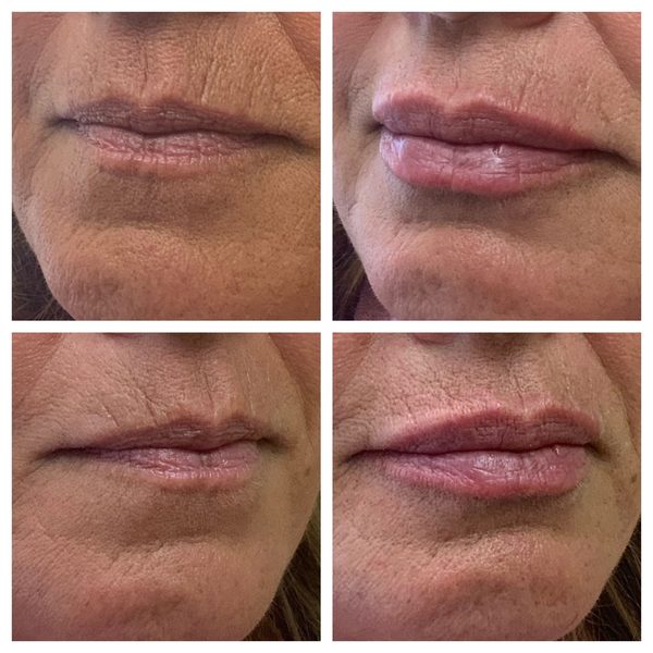 Before and after photo 3 of 16: aging lips and vertical lip lines