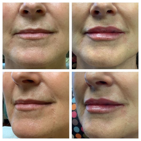 Before and after photo 6 of 16: aging lips and vertical lip lines