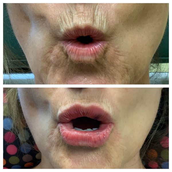 Before and after photo 7 of 16: aging lips and vertical lip lines