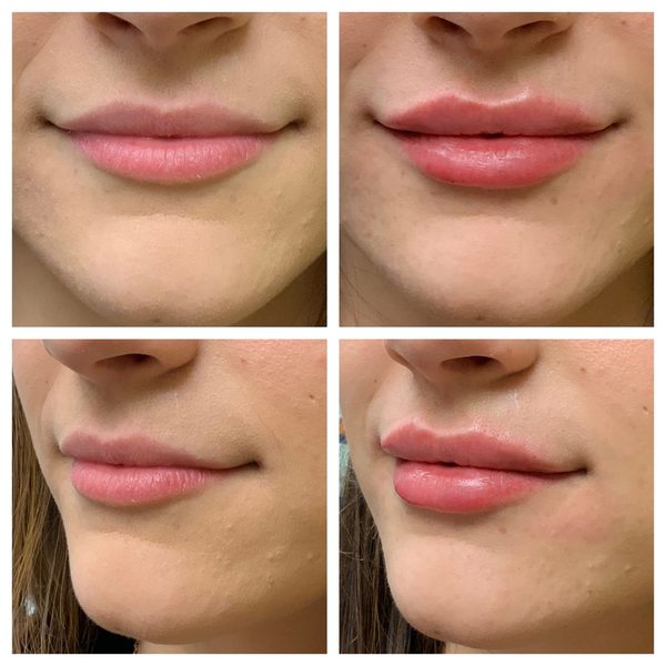 Before and after photo 7 of 12: lip volume and enhancement