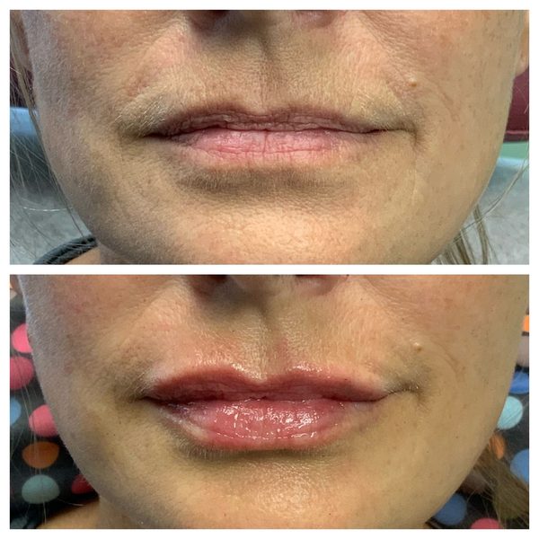 Before and after photo 2 of 12: lip volume and enhancement