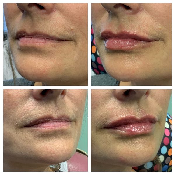Before and after photo 10 of 16: aging lips and vertical lip lines