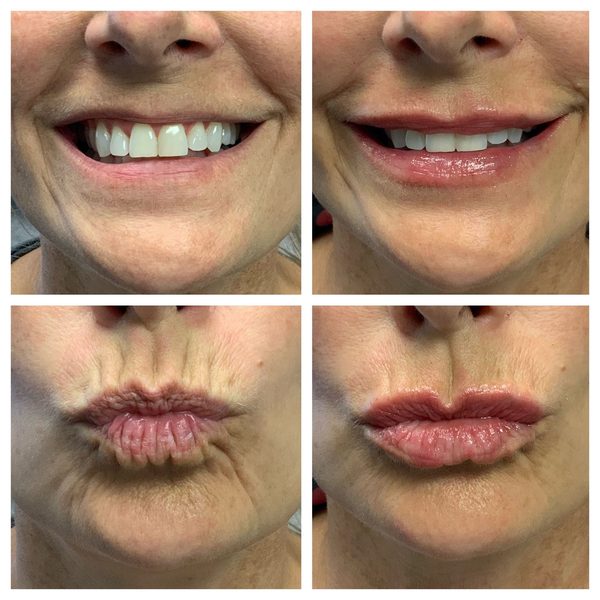 Before and after photo 8 of 16: aging lips and vertical lip lines